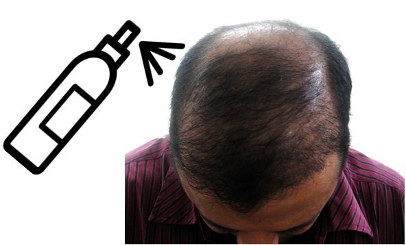 Best Bald Spot Spray